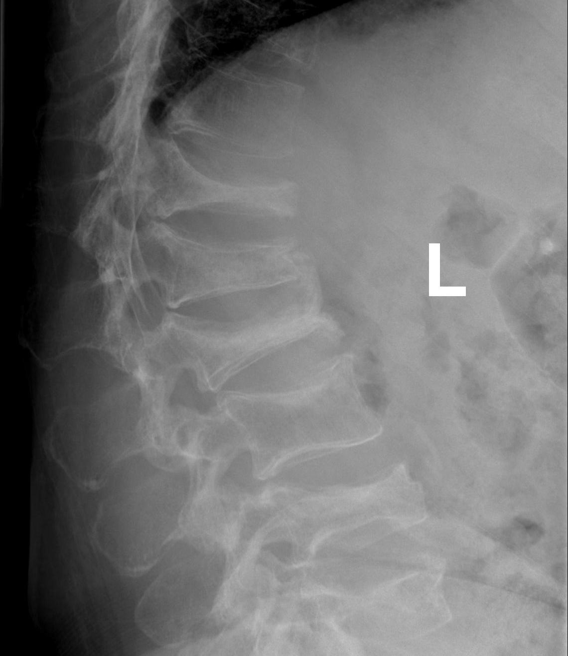 Spine Multiple Myeloma